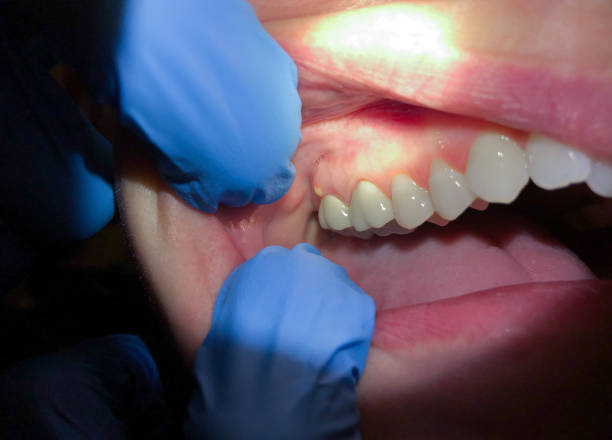 Best Chipped Tooth Repair Near Me  in Olmsted Falls, OH
